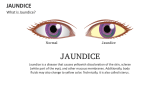 What is Jaundice? - Slide 2