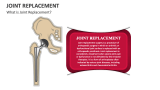 What is Joint Replacement? - Slide 2