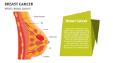 What is Breast Cancer? - Slide 2