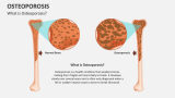 What is Osteoporosis? - Slide 2