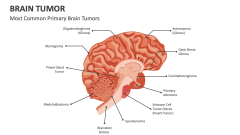Most Common Primary Brain Tumors - Slide 1