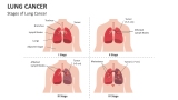 Stages of Lung Cancer - Slide 3
