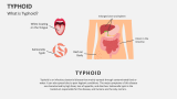 What is Typhoid? - Slide 2