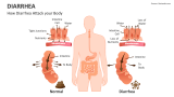 How Diarrhea Attack your Body - Slide 2