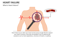 What is heart Failure? - Slide 1