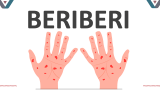 Beriberi - Slide 1