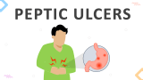 Peptic Ulcer - Slide 1