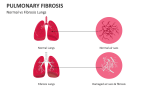 Normal vs Fibrosis Lungs - Slide 5