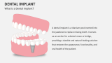 What is a Dental Implant? - Slide 1
