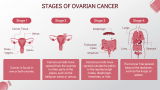 Ovarian Cancer - Slide 4