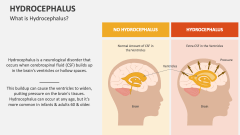 What is Hydrocephalus? - Slide 1