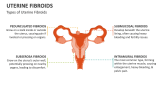 Types of Uterine Fibroids - Slide 3