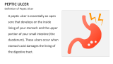 Definition of Peptic Ulcer - Slide 2