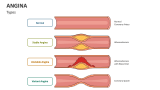 Types of Angina - Slide 2