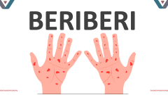 Beriberi - Slide 1