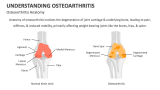 Osteoarthritis Anatomy - Slide 3