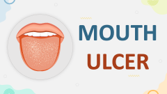 Mouth Ulcer - Slide 1