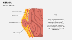 What is Hernia? - Slide 1