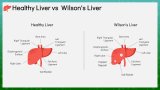 Wilson's Disease - Slide 7