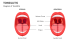 Diagram of Tonsillitis - Slide 4
