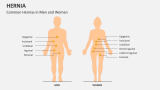 Common Hernias in Men and Women - Slide 2