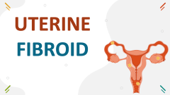 Uterine Fibroids - Slide 1